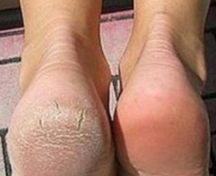 Callosités talonnières